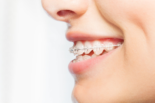Caring for Braces at Home