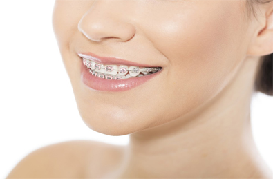 This is the image for the news article titled Adolescent Orthodontic Treatment